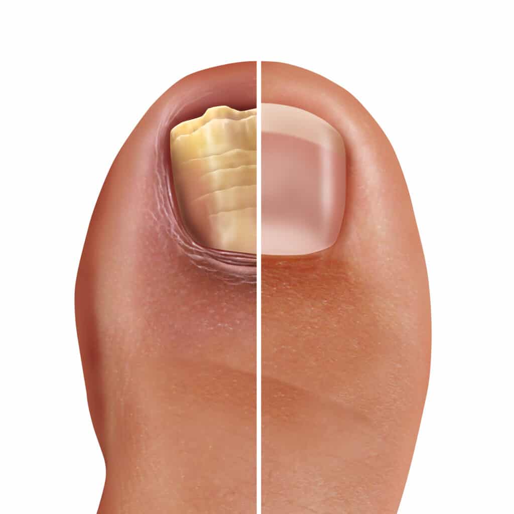 Fungal nail infection and onychomycosisor tinea unguium as an infected foot toenail or toe nail with damaged unhealthy and healthy human anatomy in a 3D illustration style.