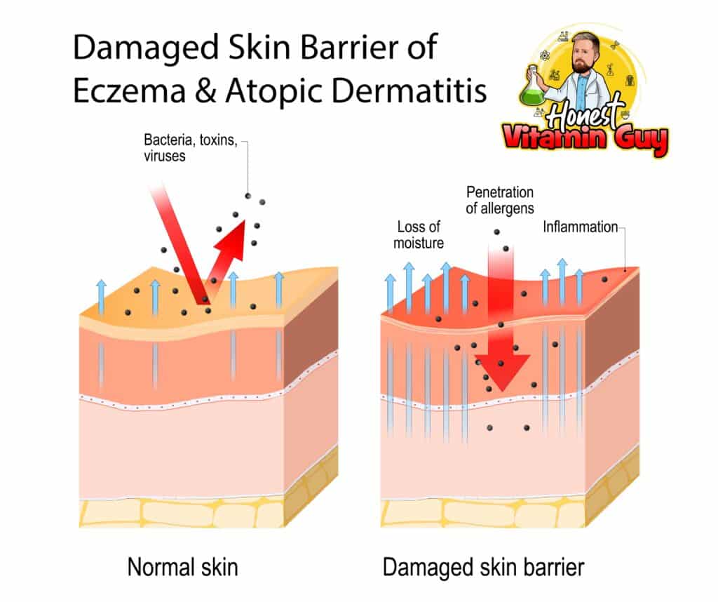 Dermatitis. Normal and skin with Damaged barrier. protection effect. The difference between healthy and dry skin