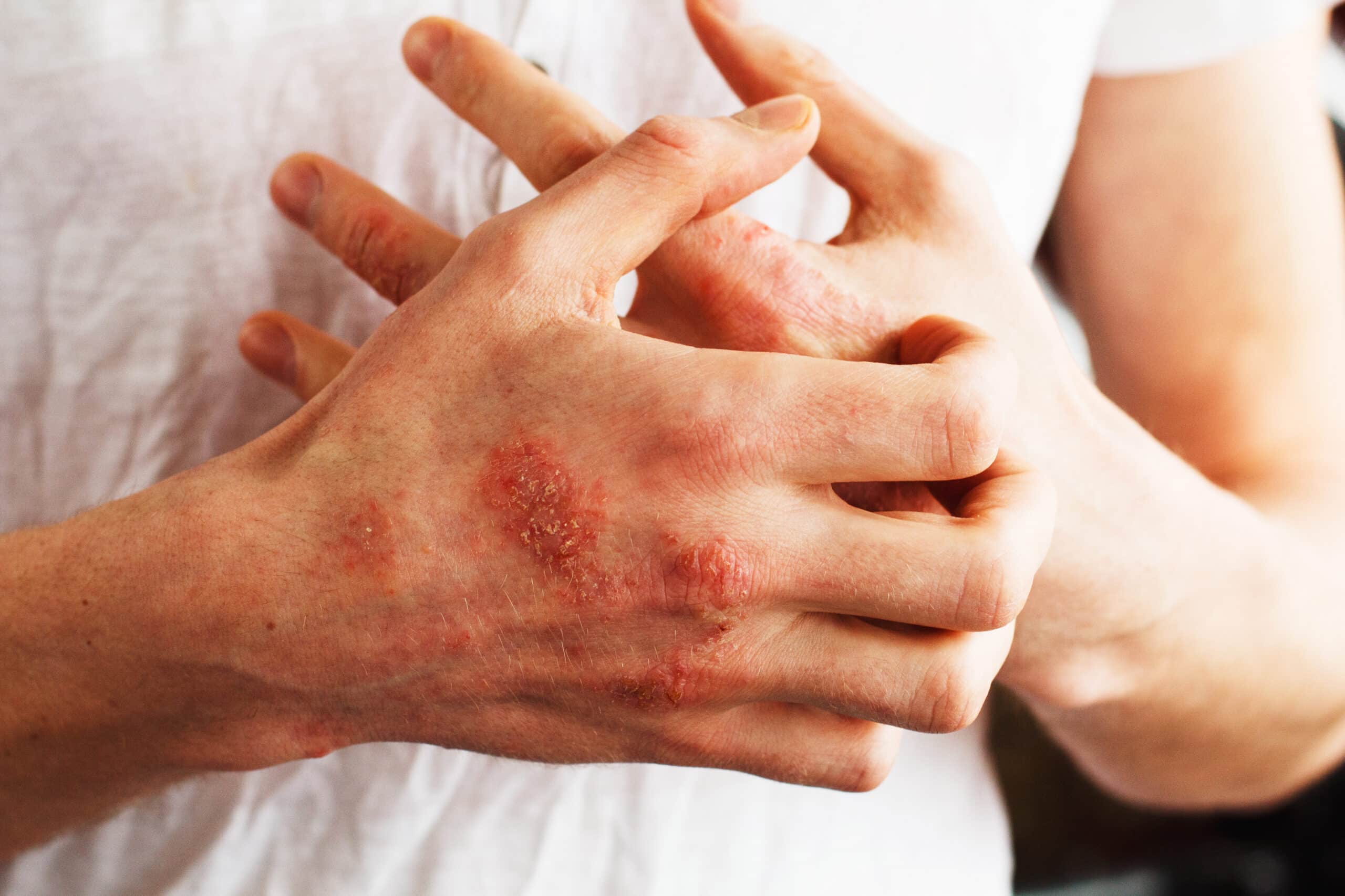 Man scratch oneself, dry flaky skin on hand with psoriasis vulgaris, eczema and other skin conditions like fungus, plaque, rash and patches.