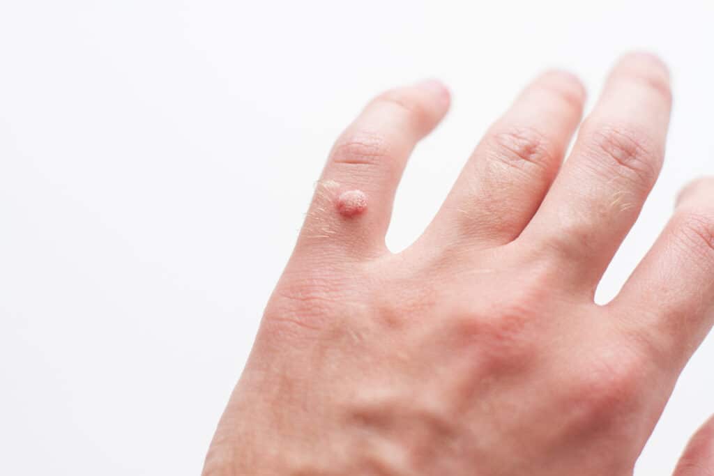 Many warts on hand